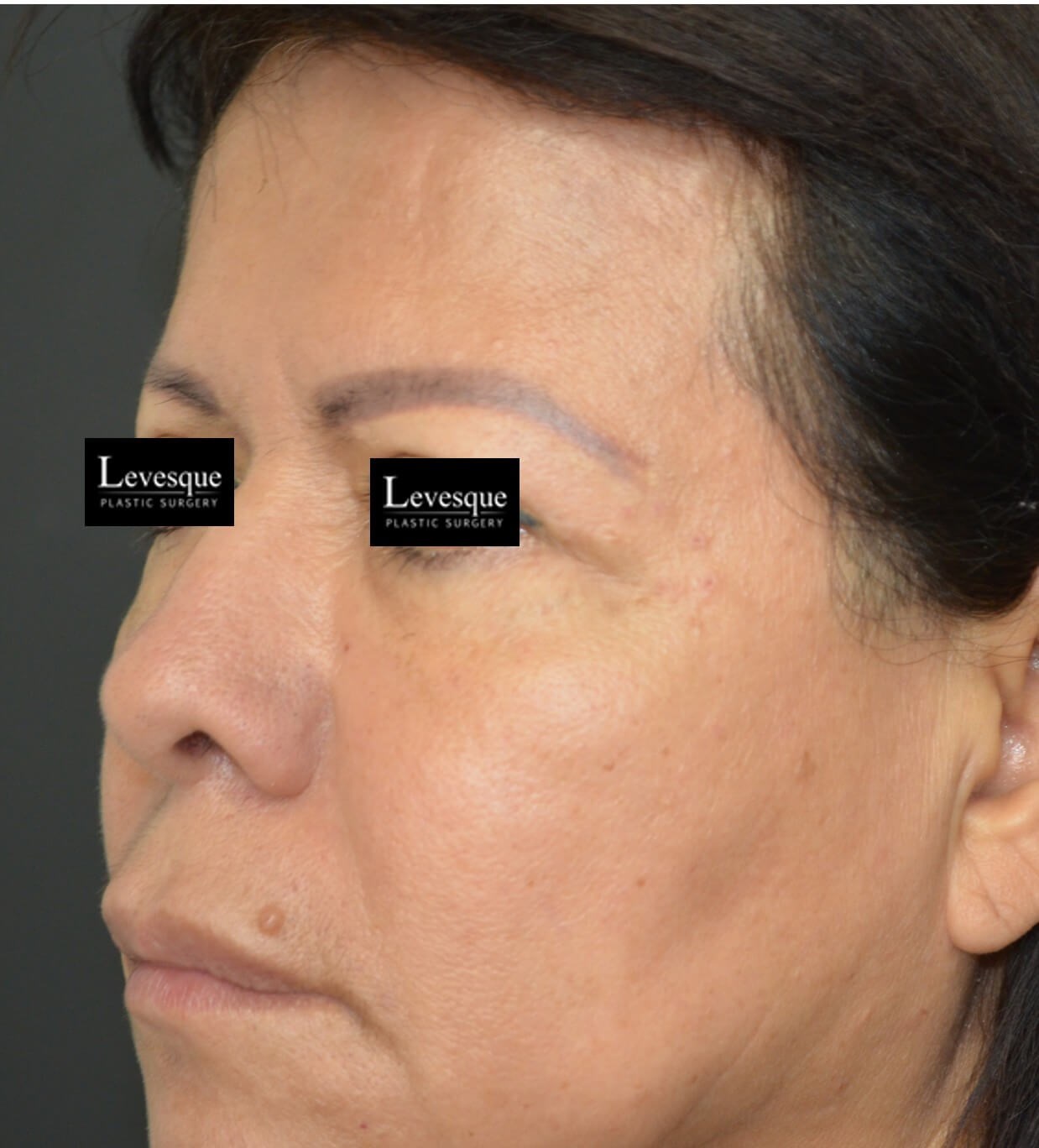 Hairline Browlift Before
