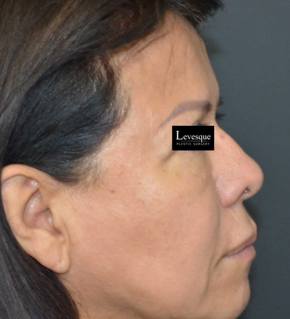 Hairline Browlift Before