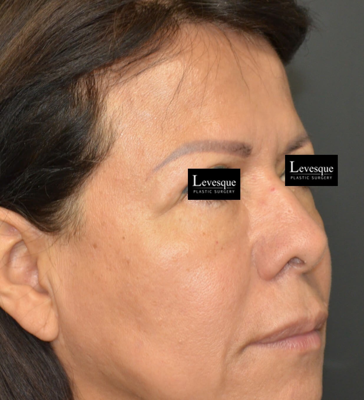 Hairline Browlift Before