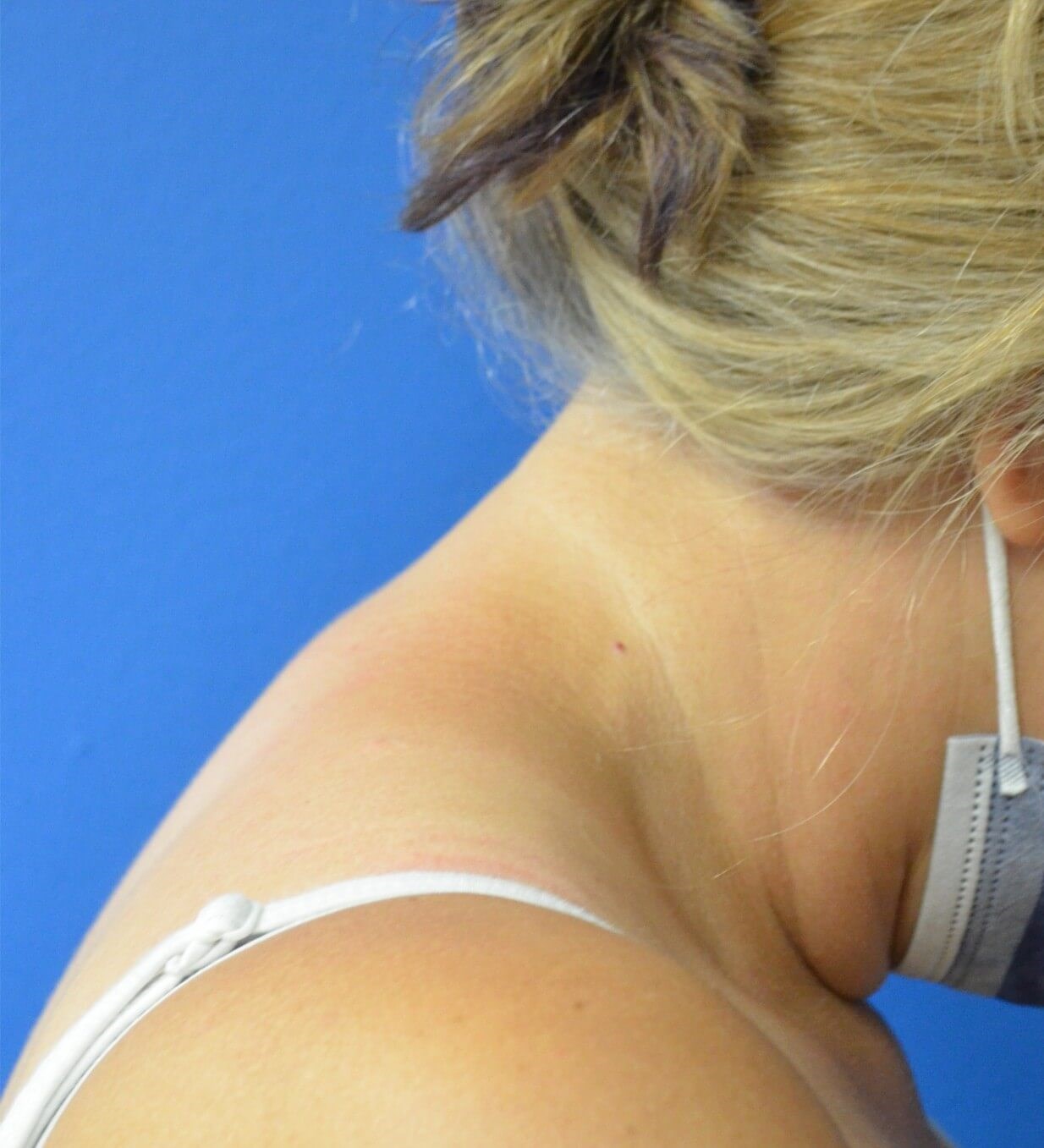 Vaser Liposcution upper back After