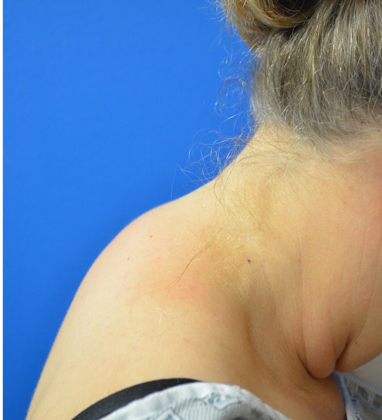 Vaser Liposcution upper back Before