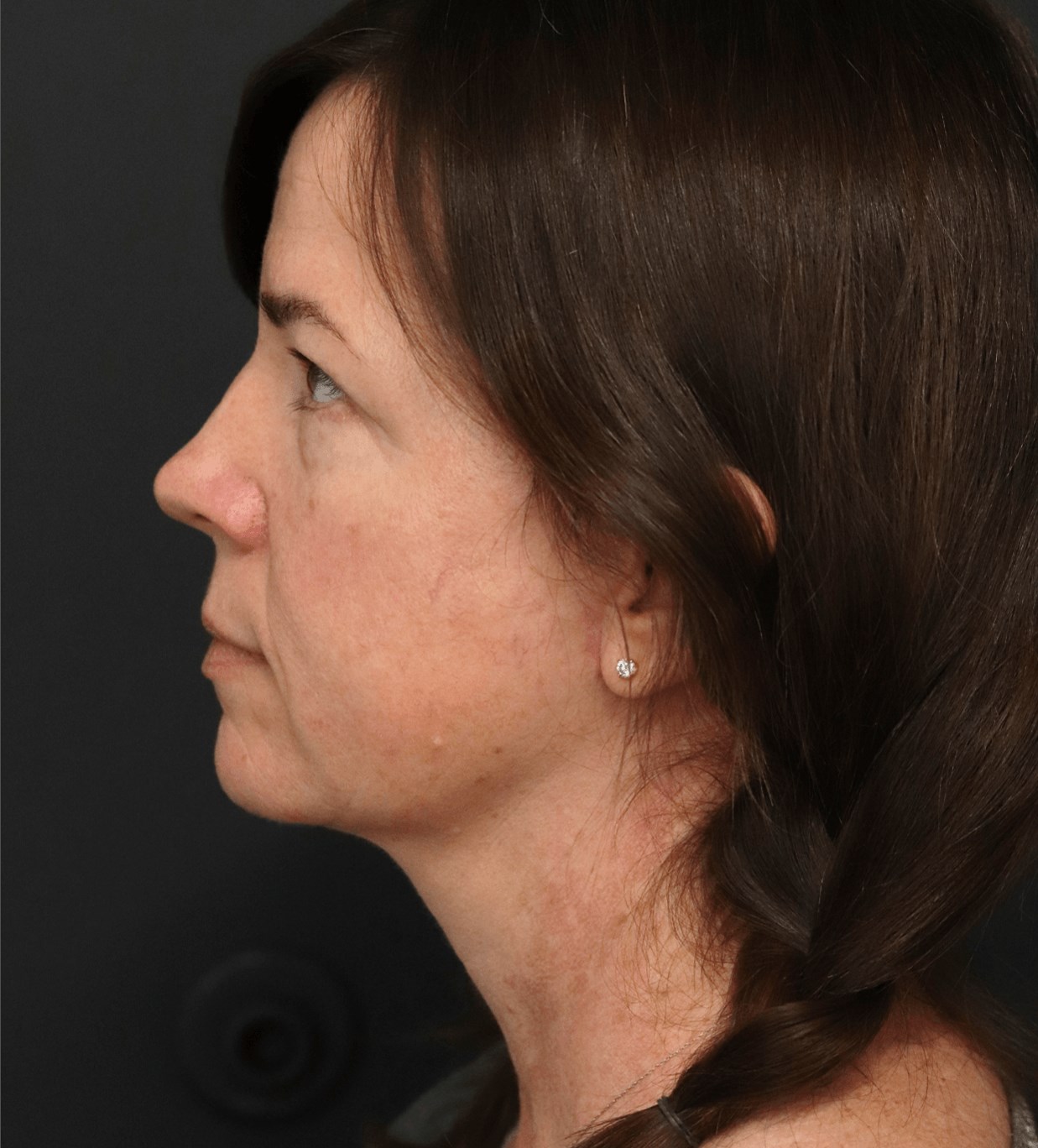 Deep plane face and necklift After