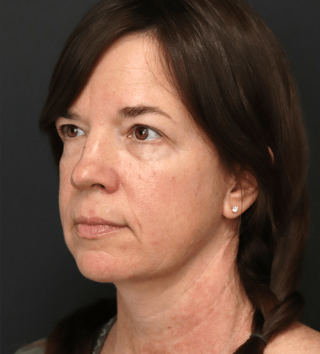 Deep plane face and necklift After