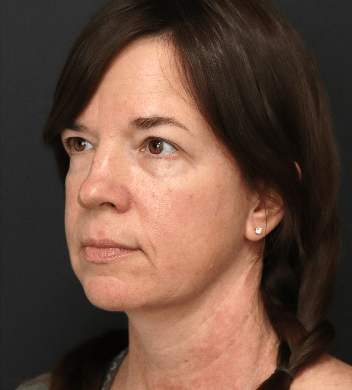 Deep plane face and necklift After