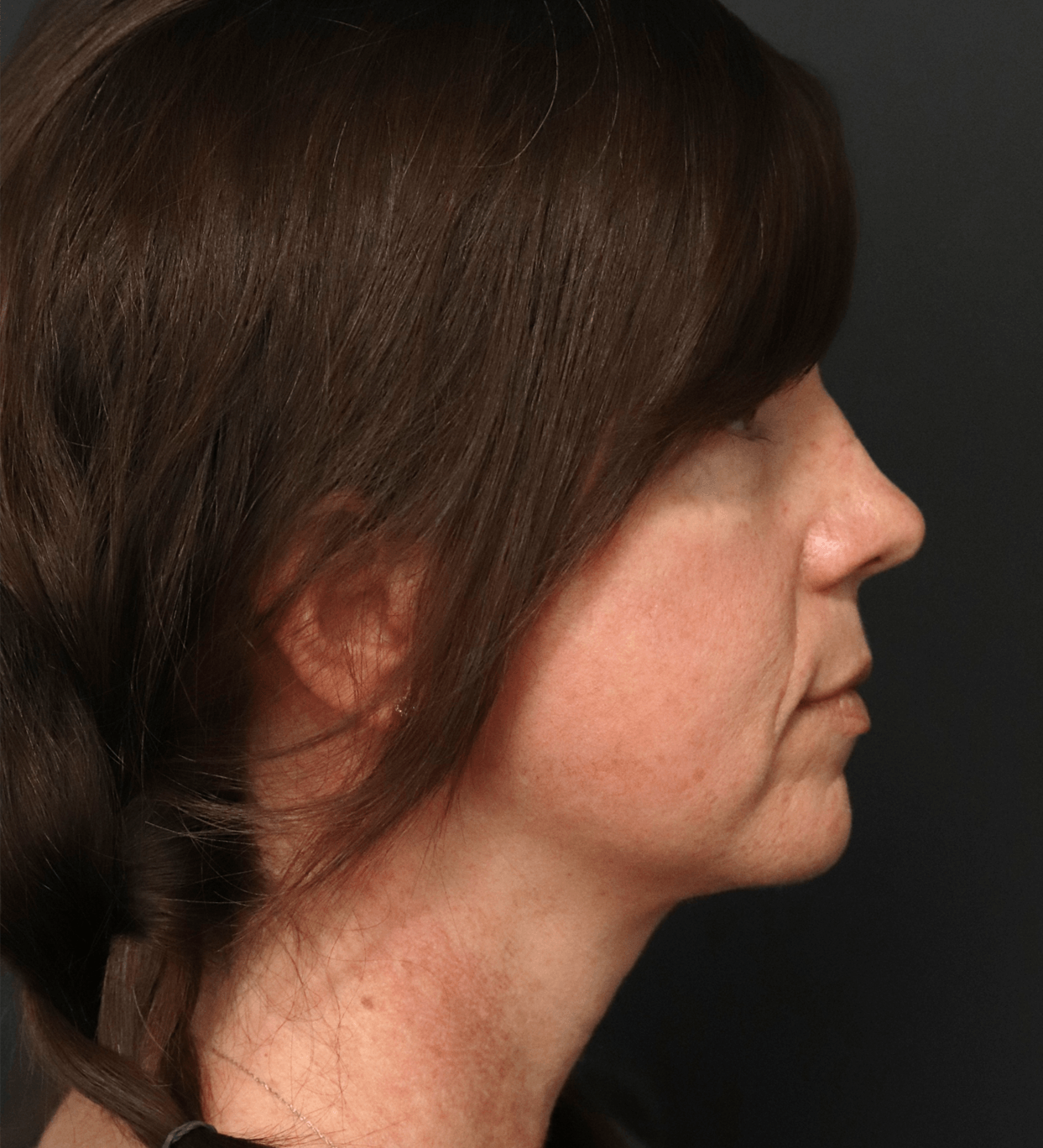 Deep plane face and necklift After