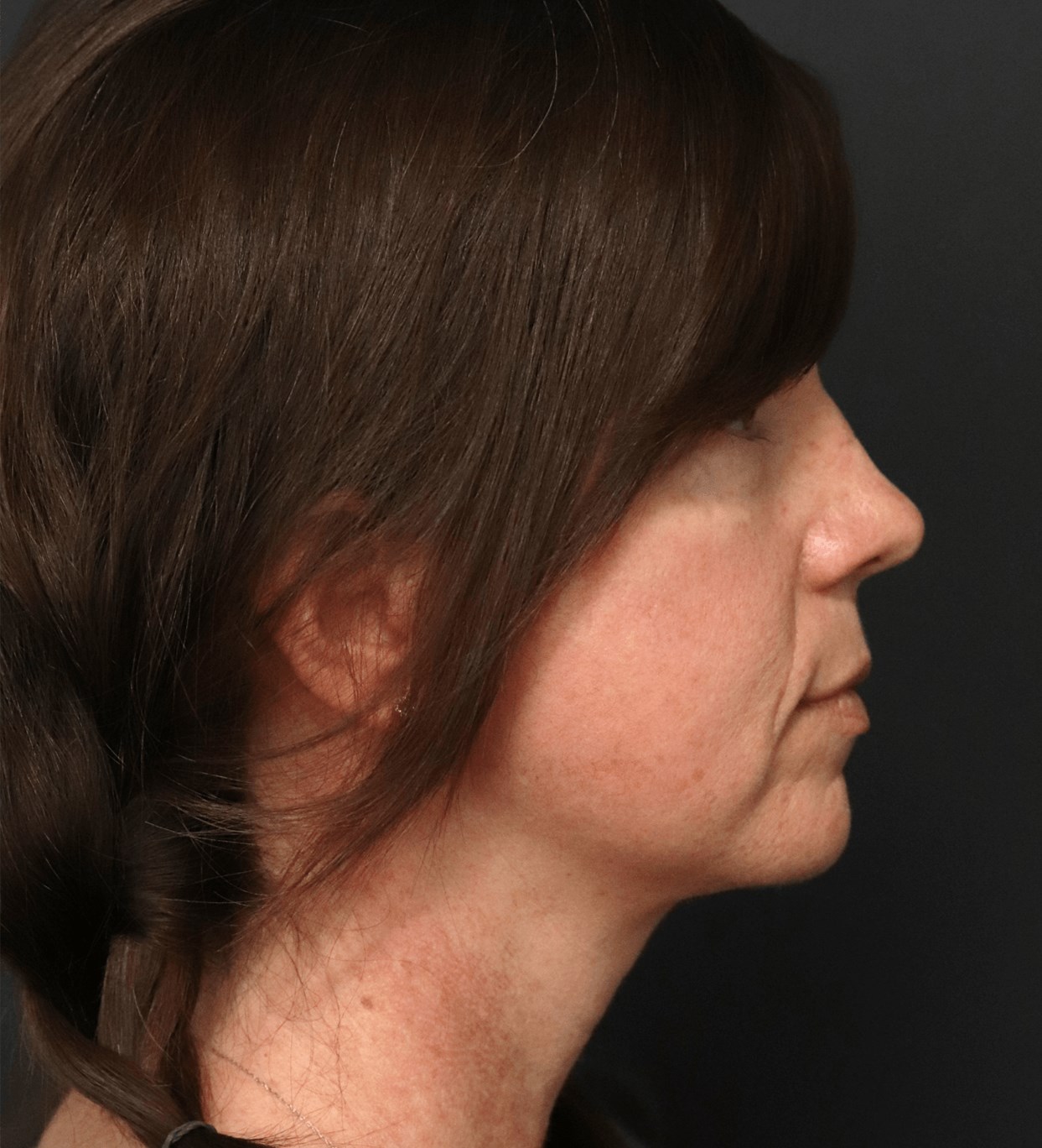 Deep plane face and necklift After