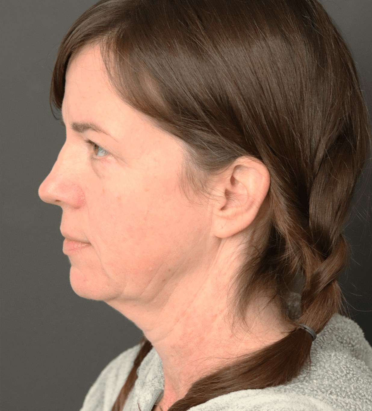Deep plane face and necklift Before