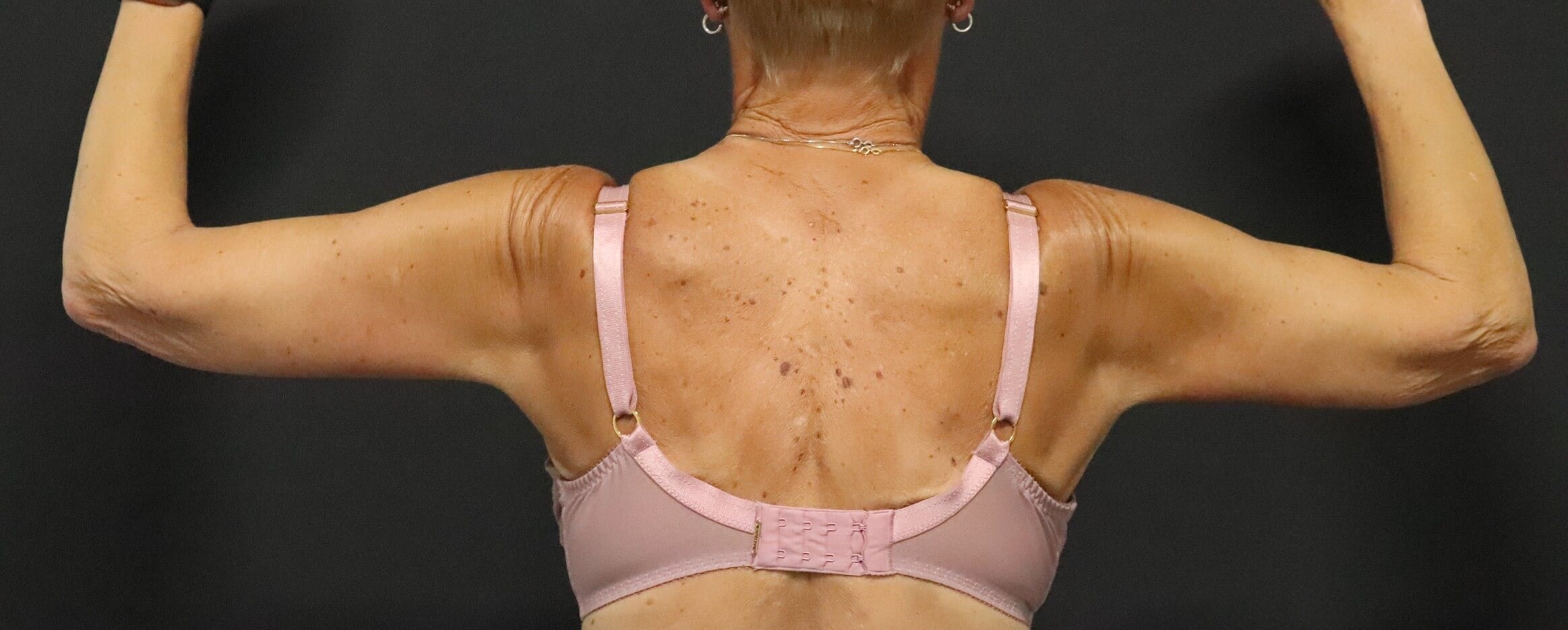 Brachioplasty or Arm Lift After