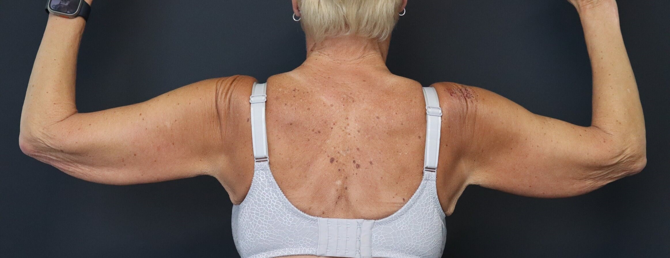 Brachioplasty or Arm Lift Before