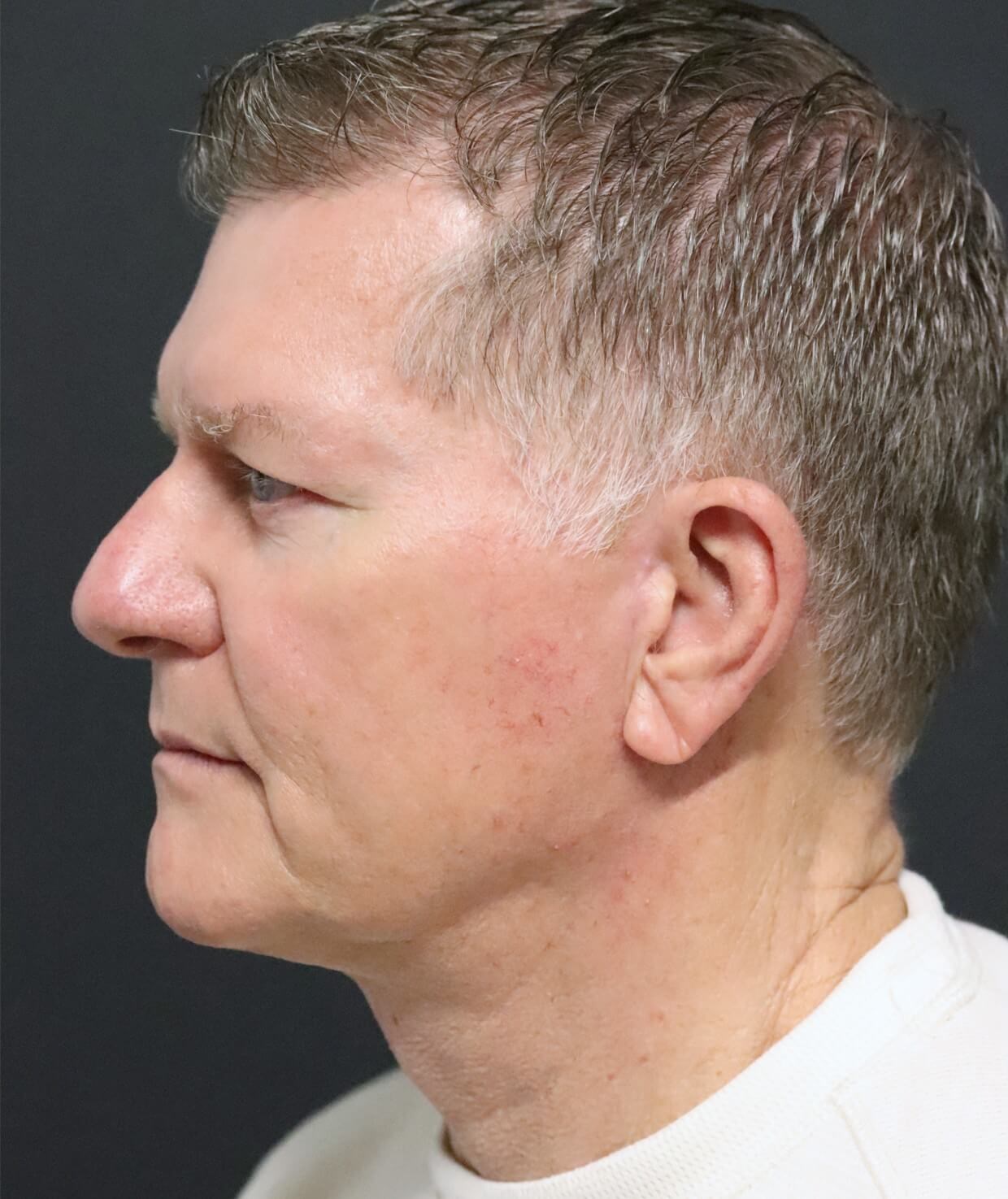 Deep plane face and necklift After