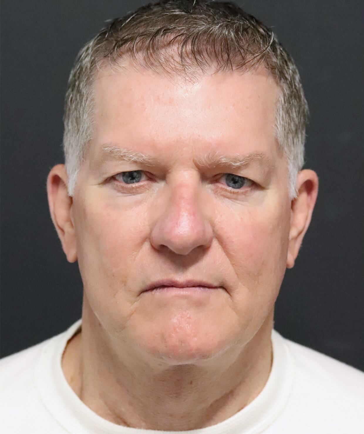 Deep plane face and necklift After