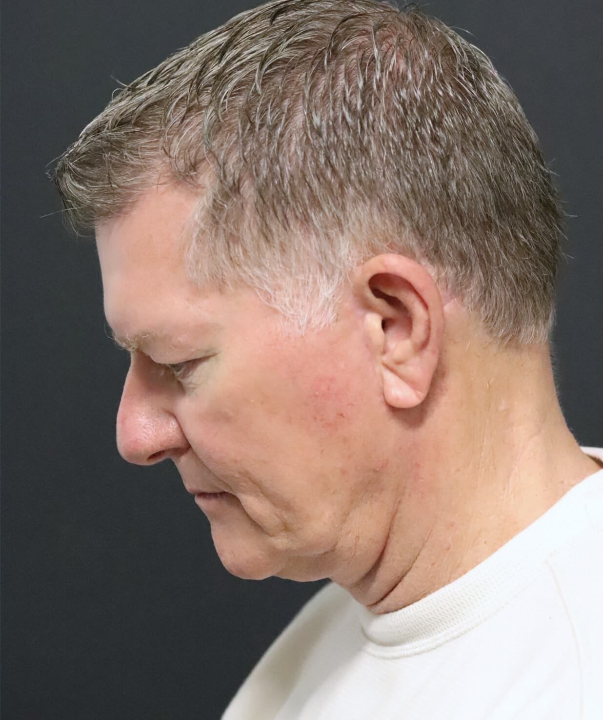 Deep plane face and necklift After