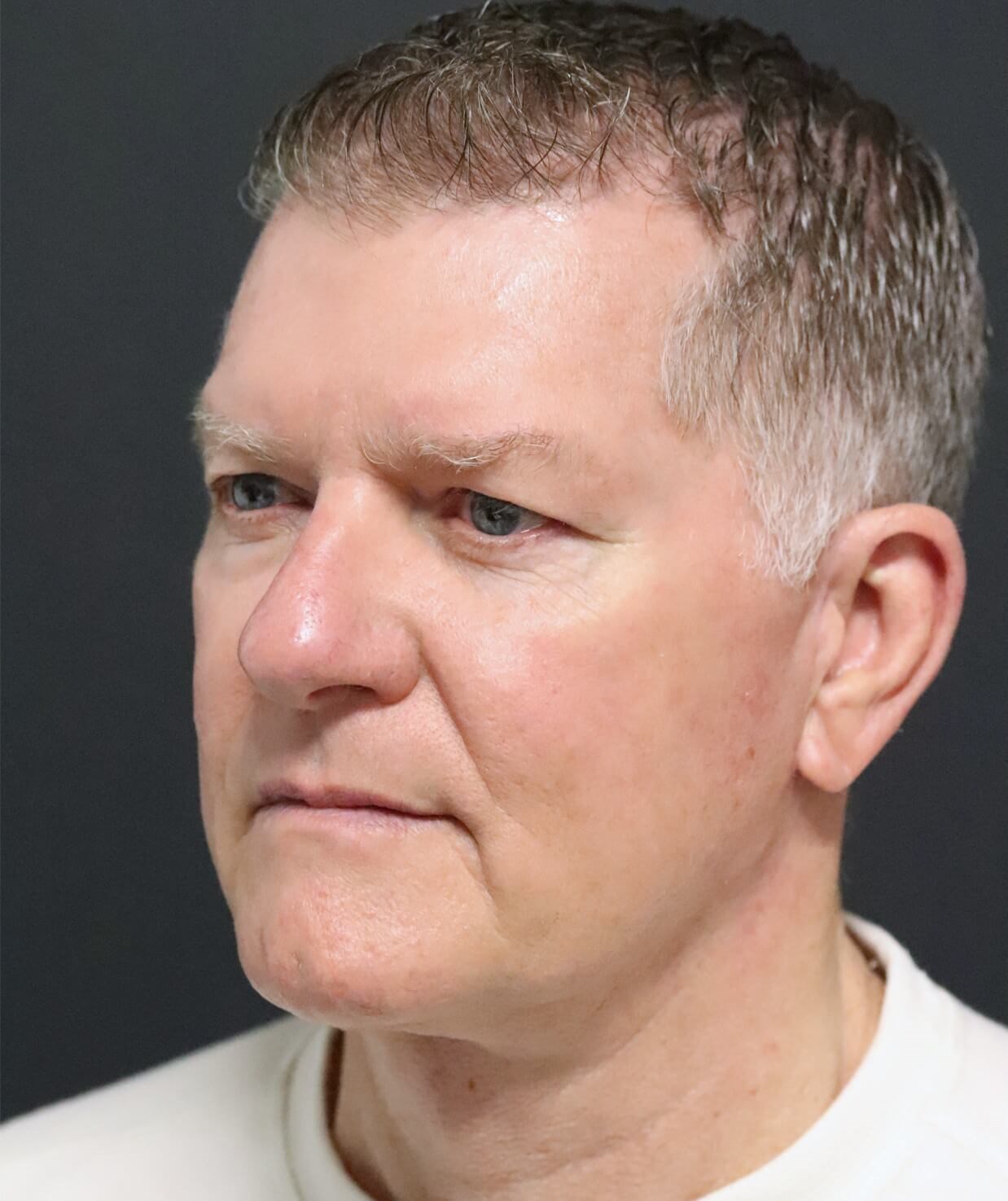 Deep plane face and necklift After