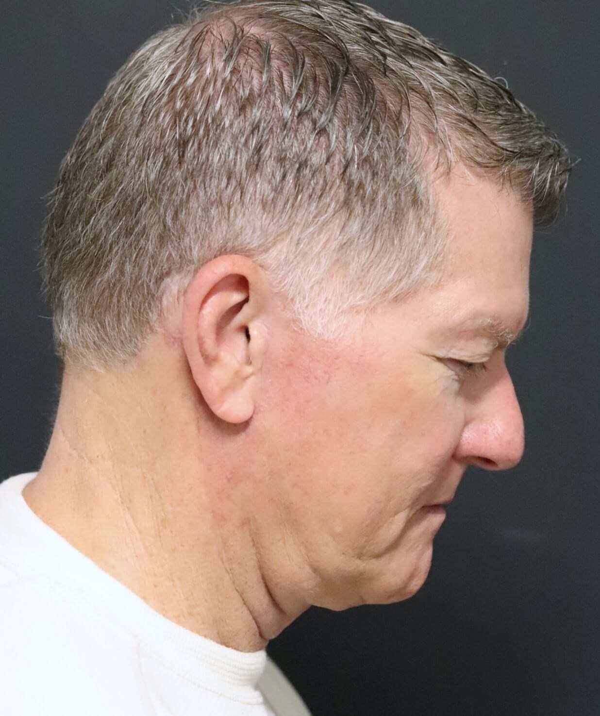 Deep plane face and necklift After