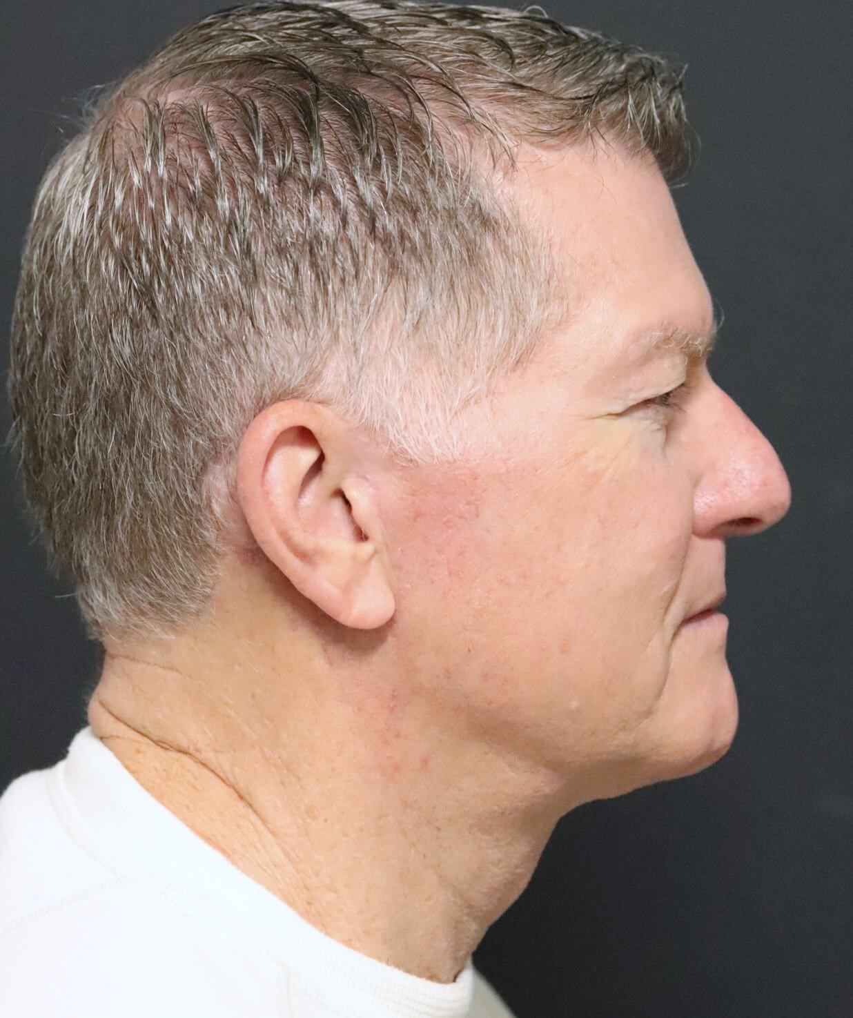 Deep plane face and necklift After