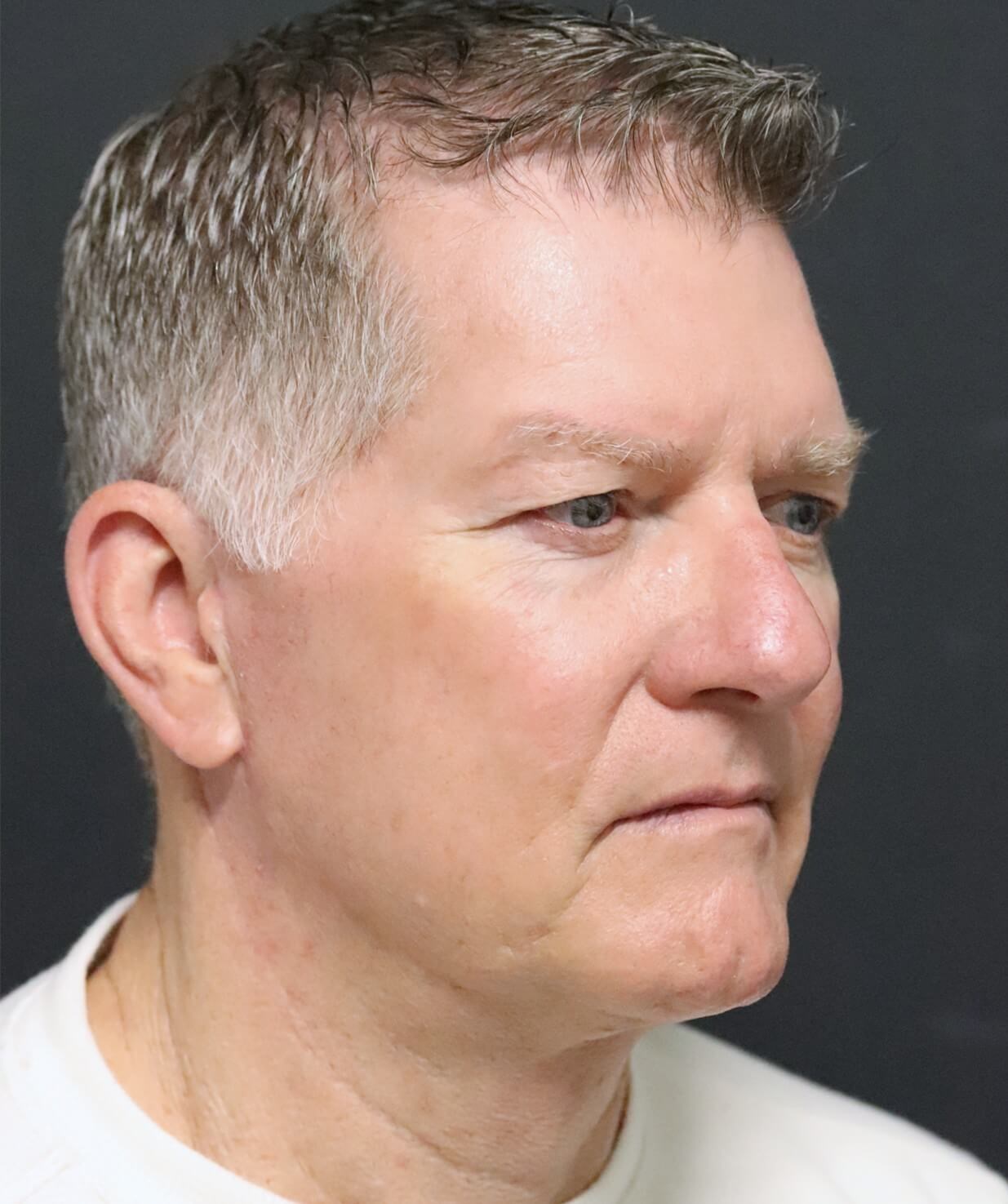 Deep plane face and necklift After