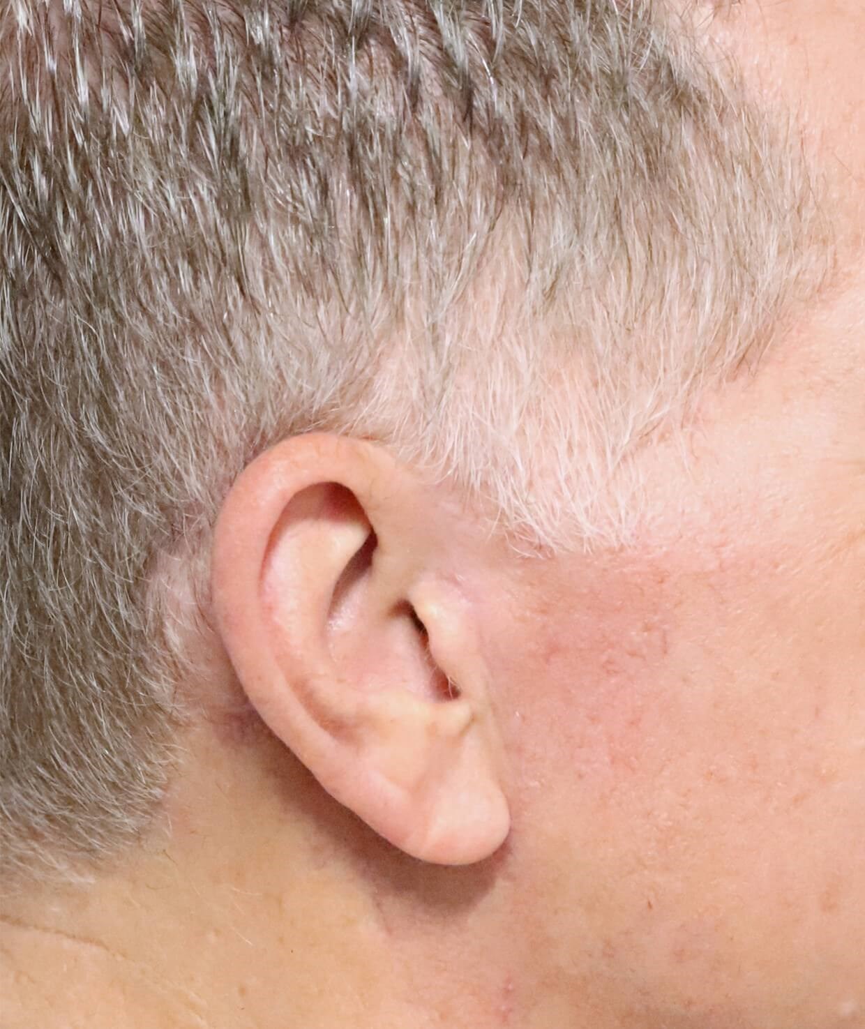 Deep plane face and necklift After