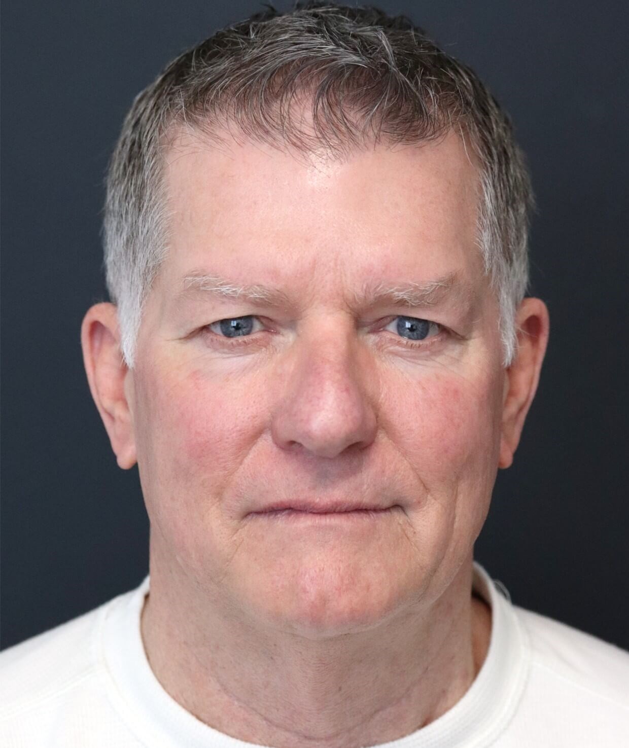 Deep plane face and necklift Before