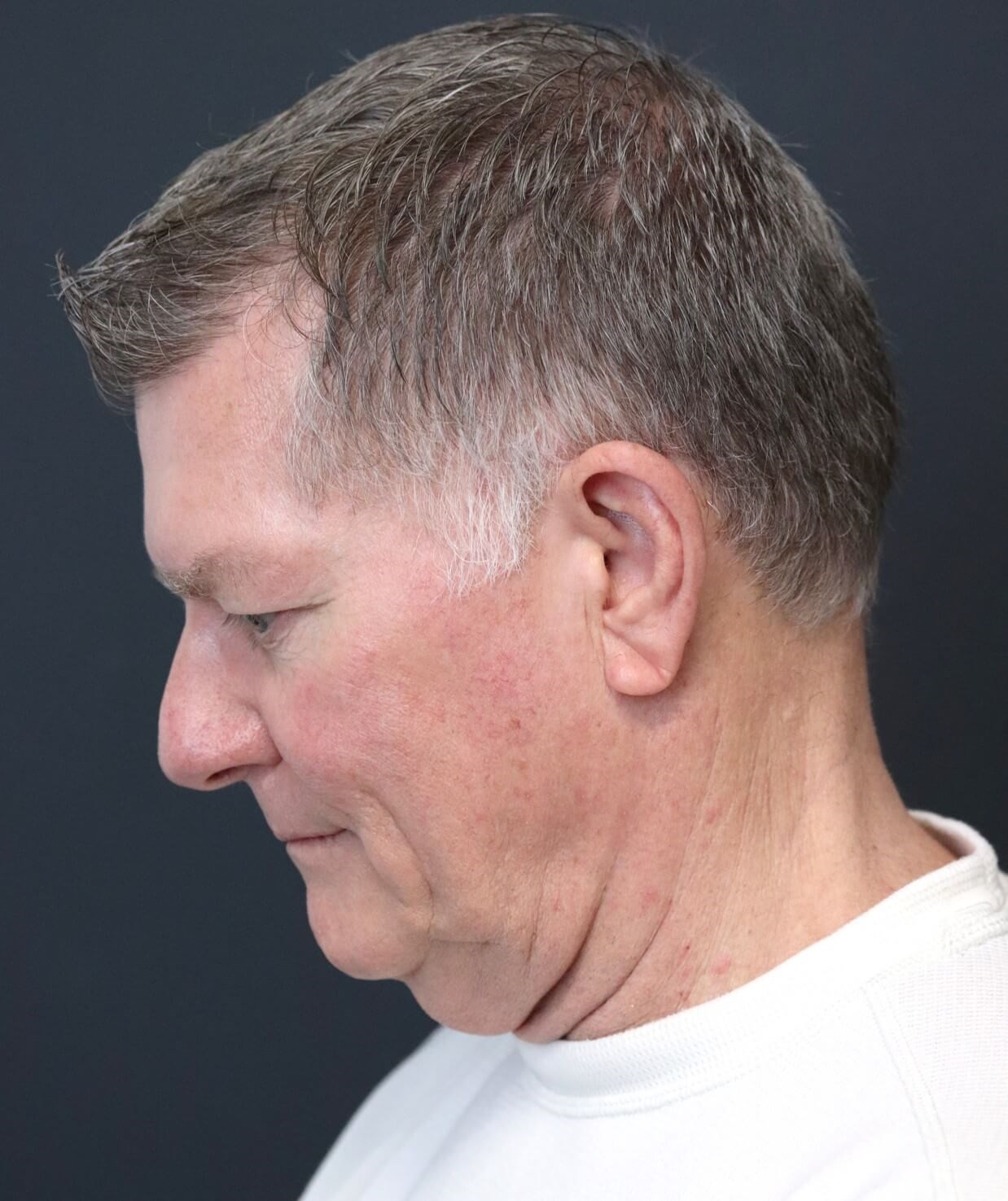 Deep plane face and necklift Before