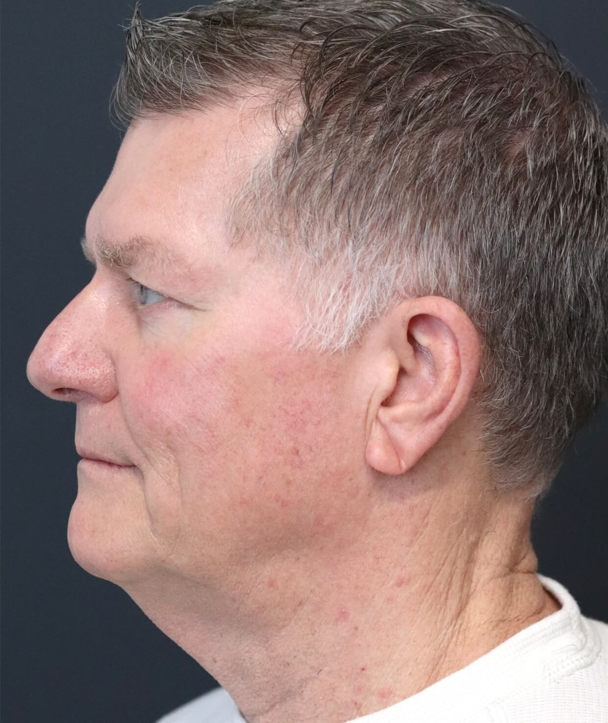 Deep plane face and necklift Before