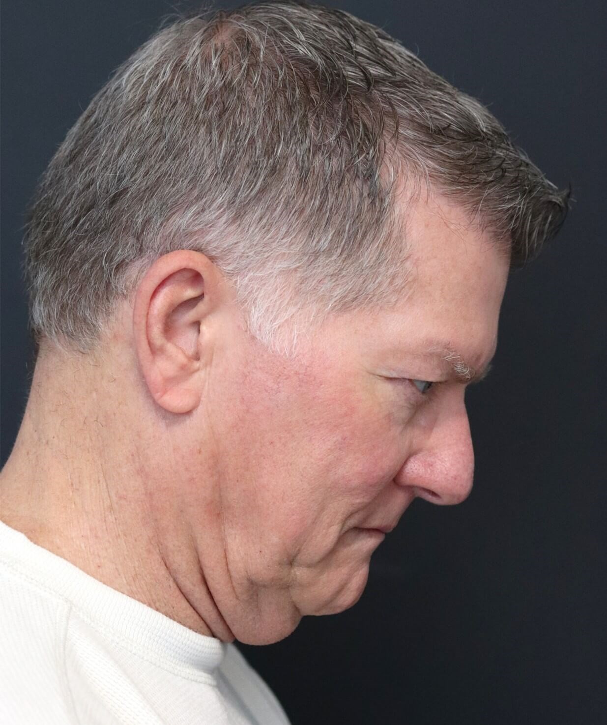 Deep plane face and necklift Before