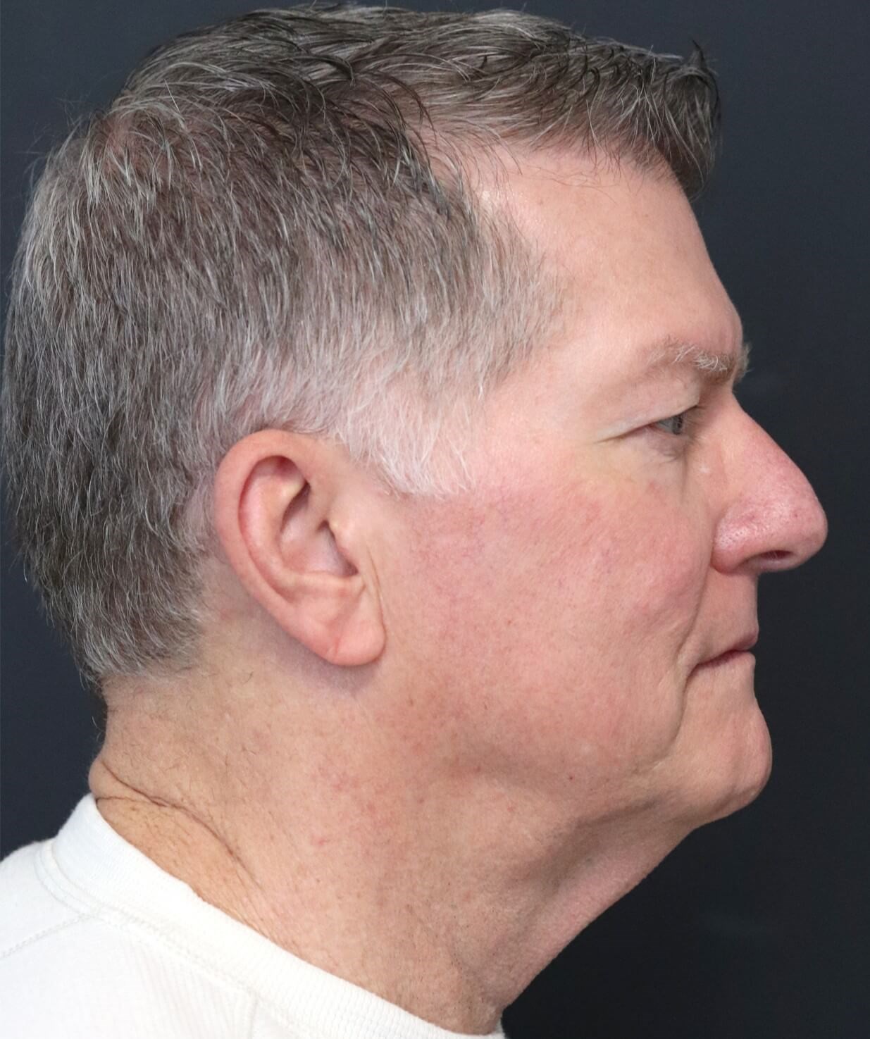 Deep plane face and necklift Before