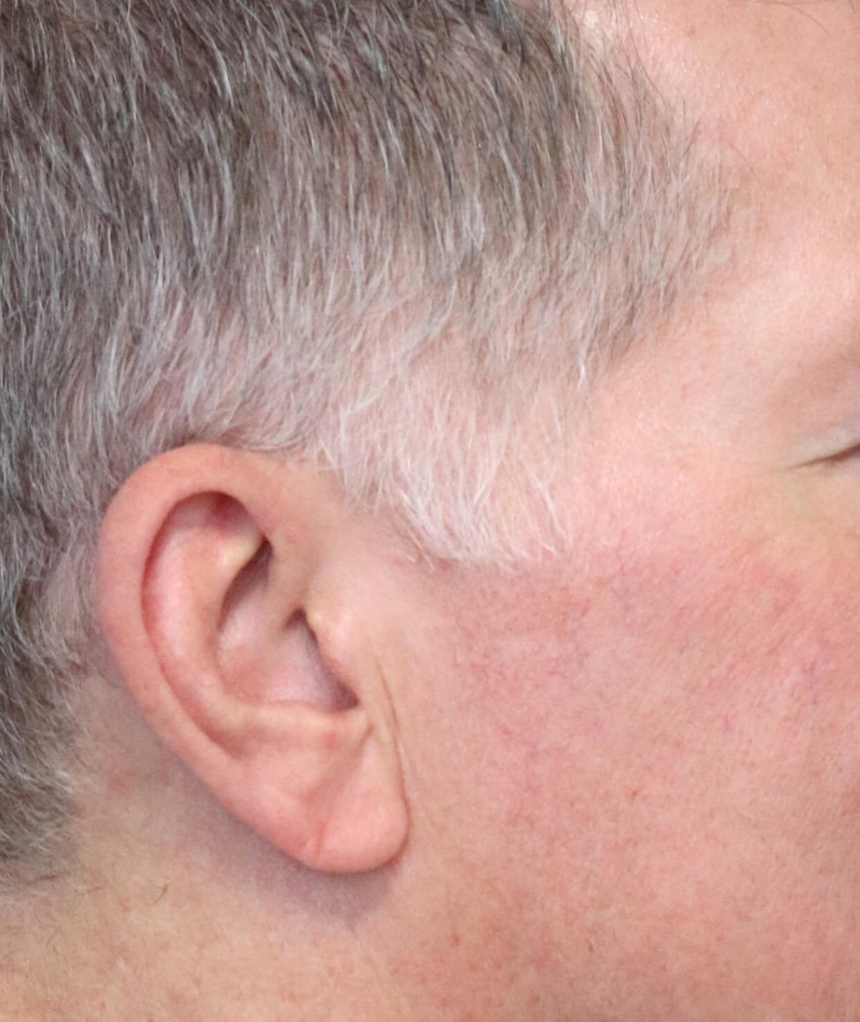 Deep plane face and necklift Before