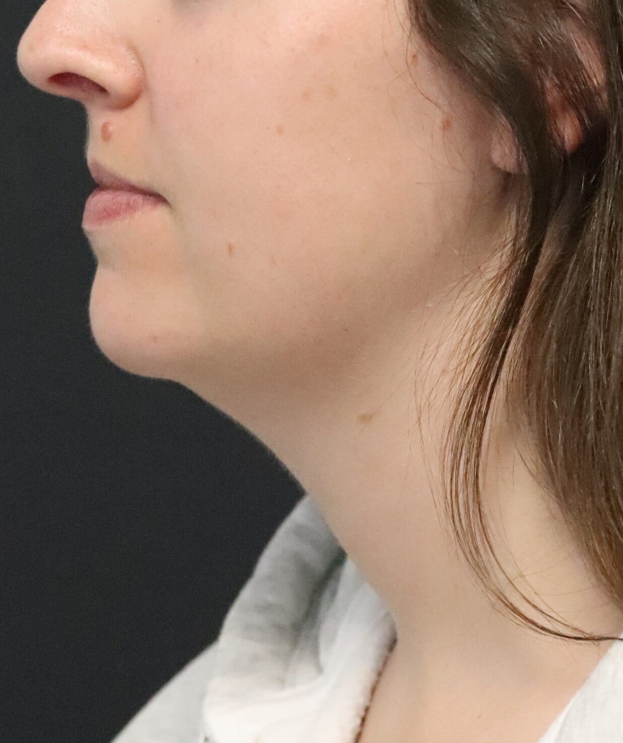 Deep Neck Contouring Before