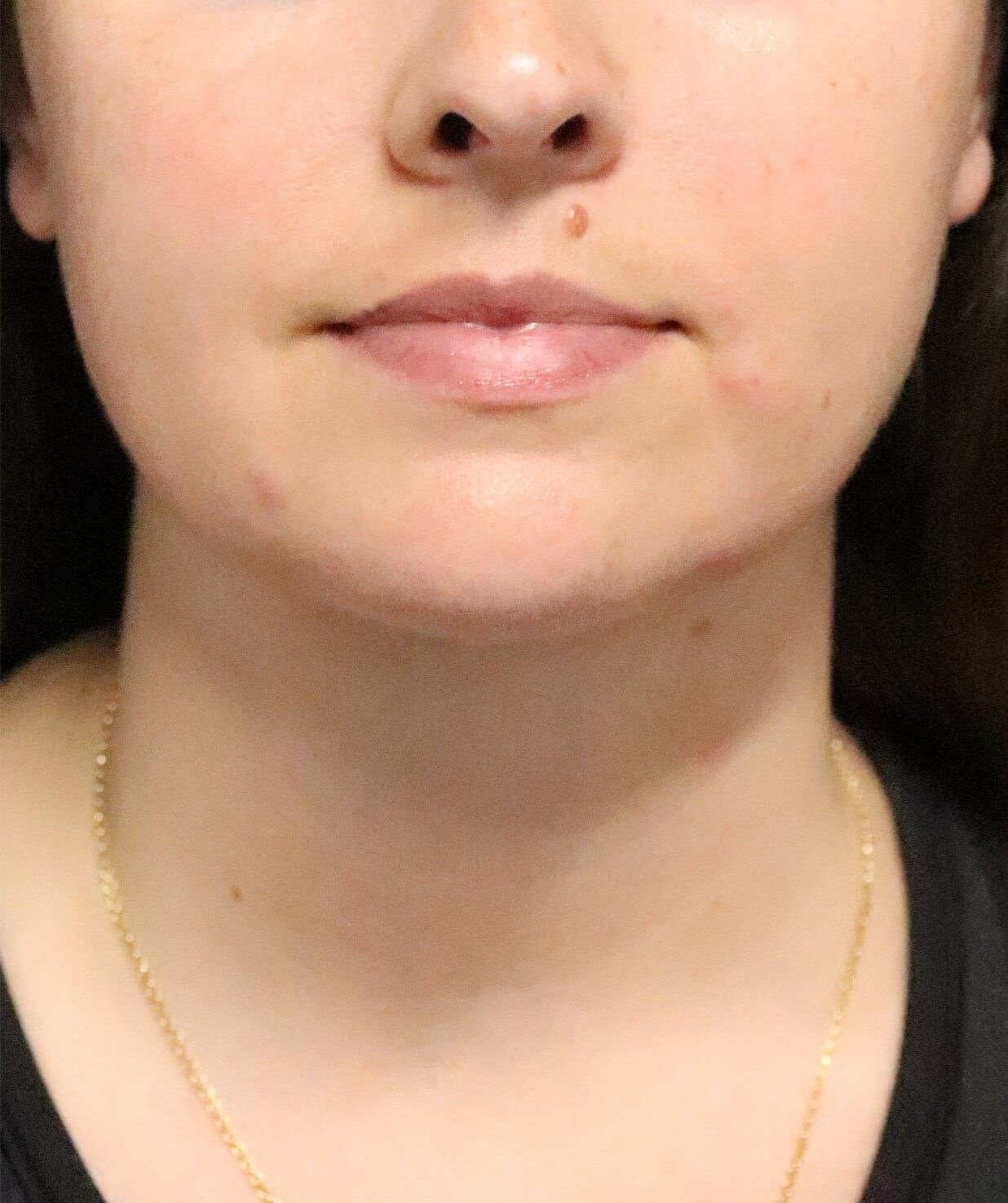 Deep Neck Contouring After