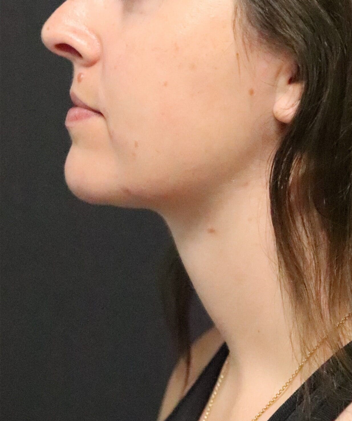 Deep Neck Contouring After