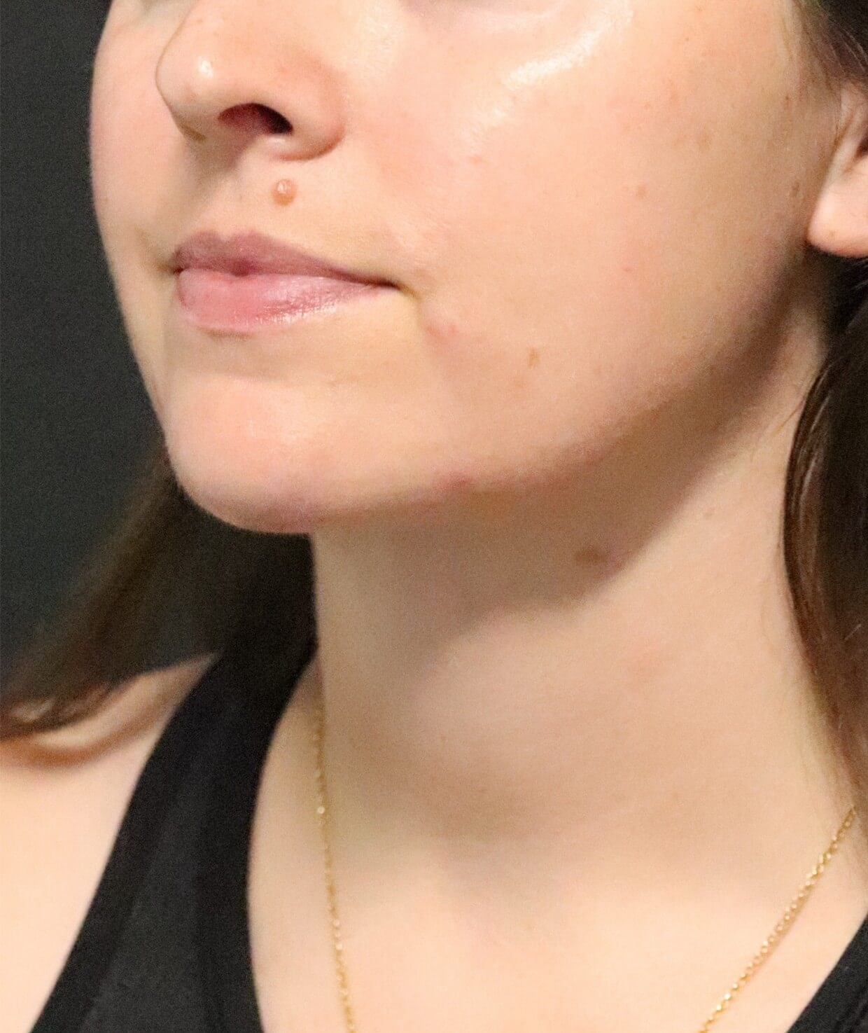 Deep Neck Contouring After