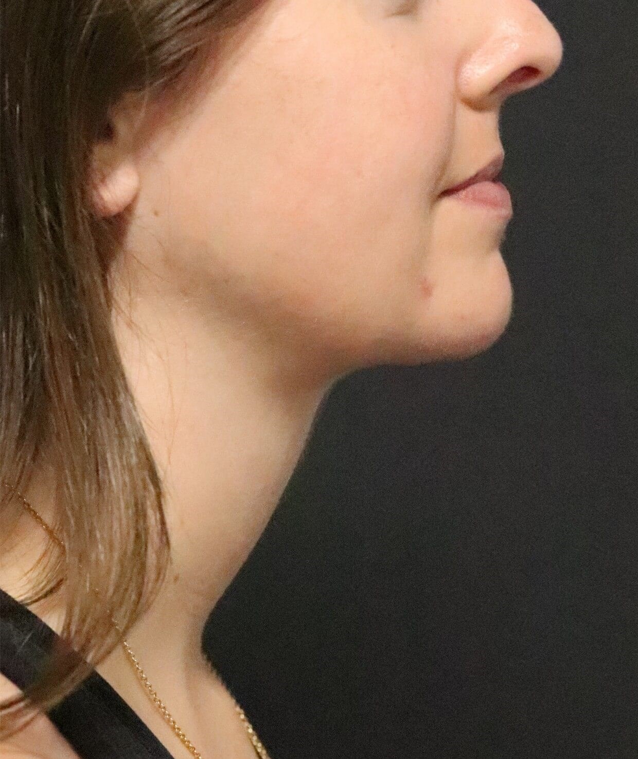 Deep Neck Contouring After