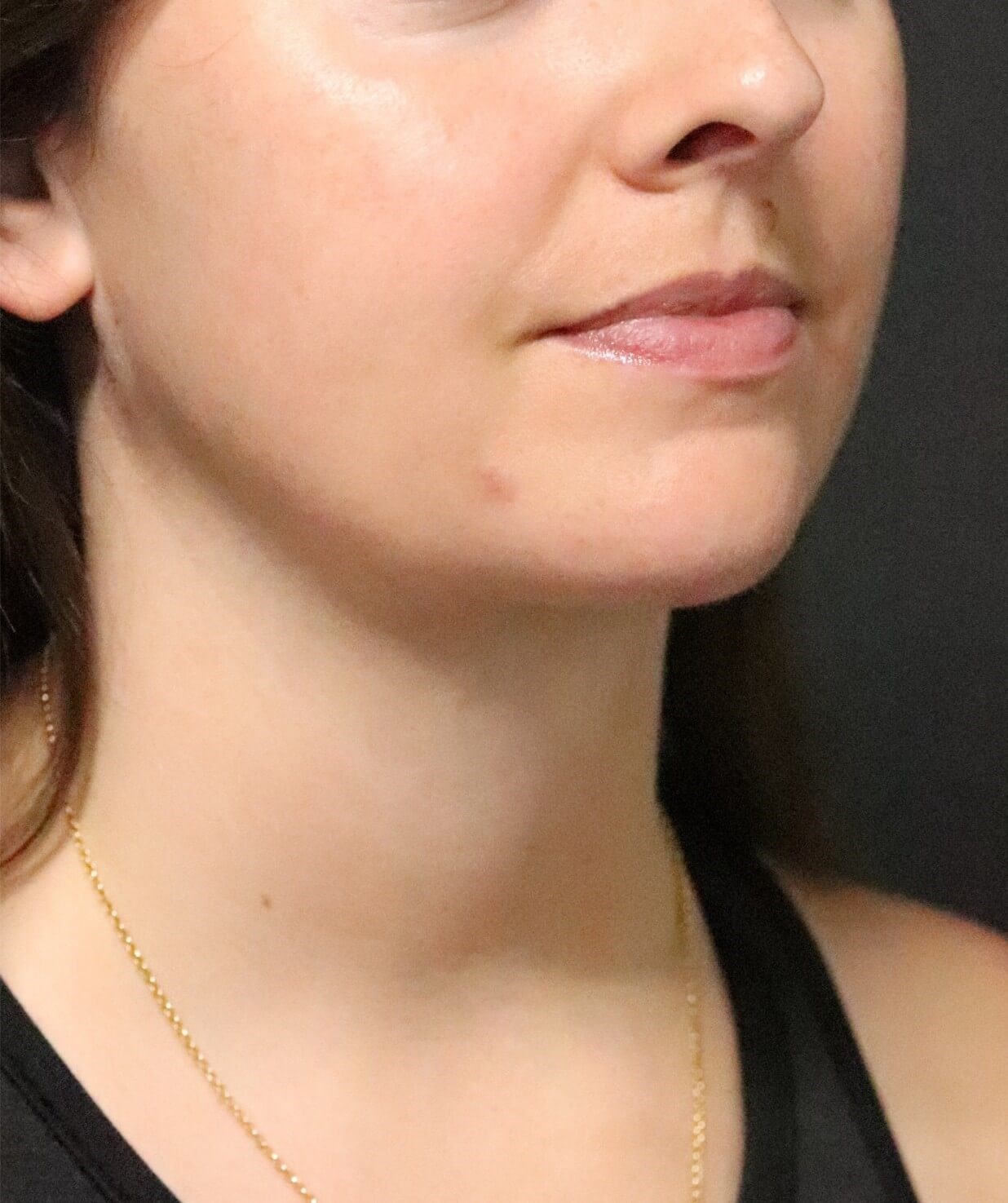 Deep Neck Contouring After