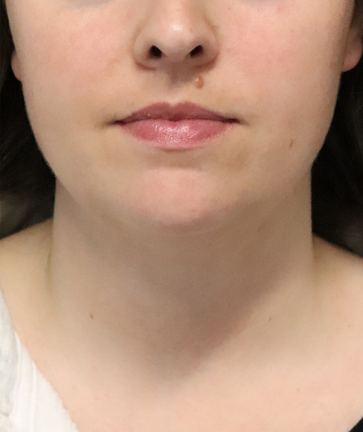 Deep Neck Contouring Before