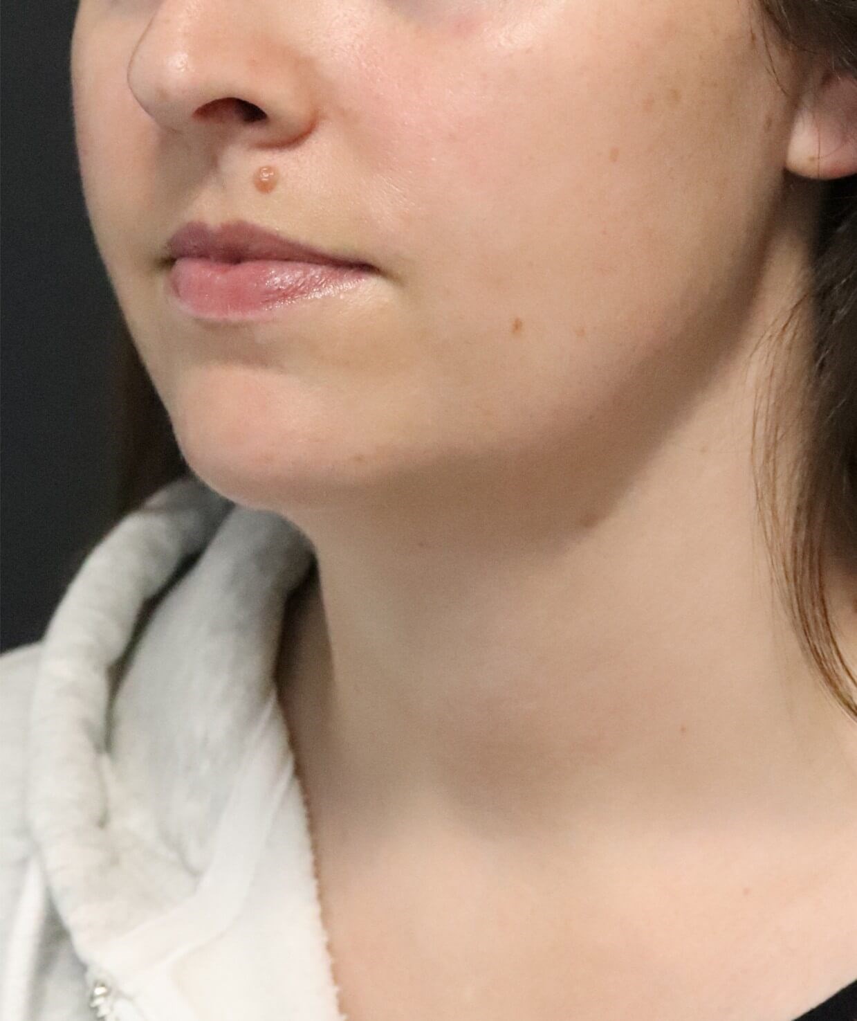 Deep Neck Contouring Before