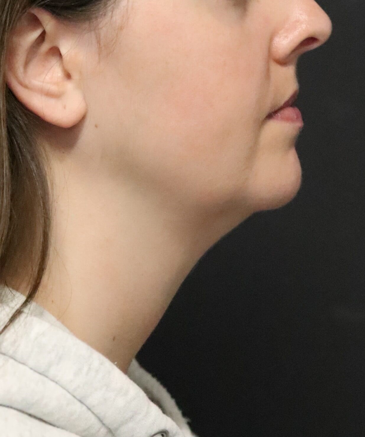 Deep Neck Contouring Before