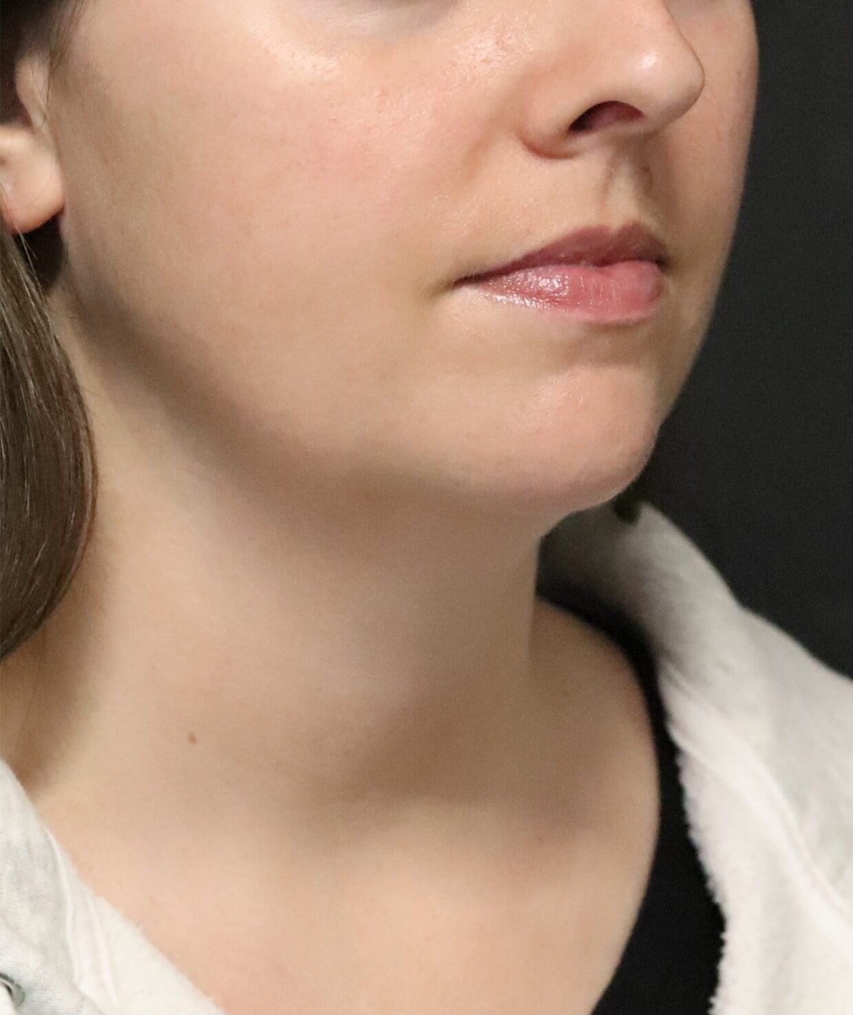 Deep Neck Contouring Before