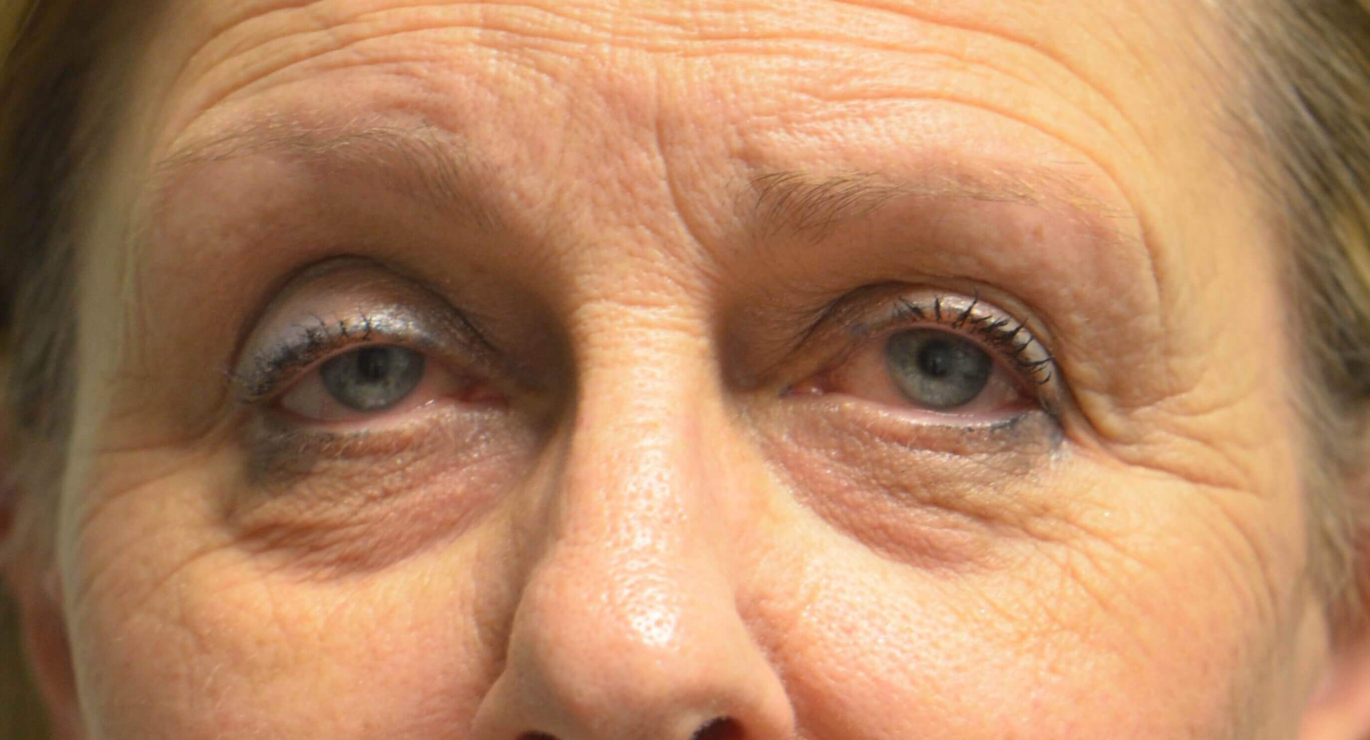 Blepharplasty Ptosis Repair Before