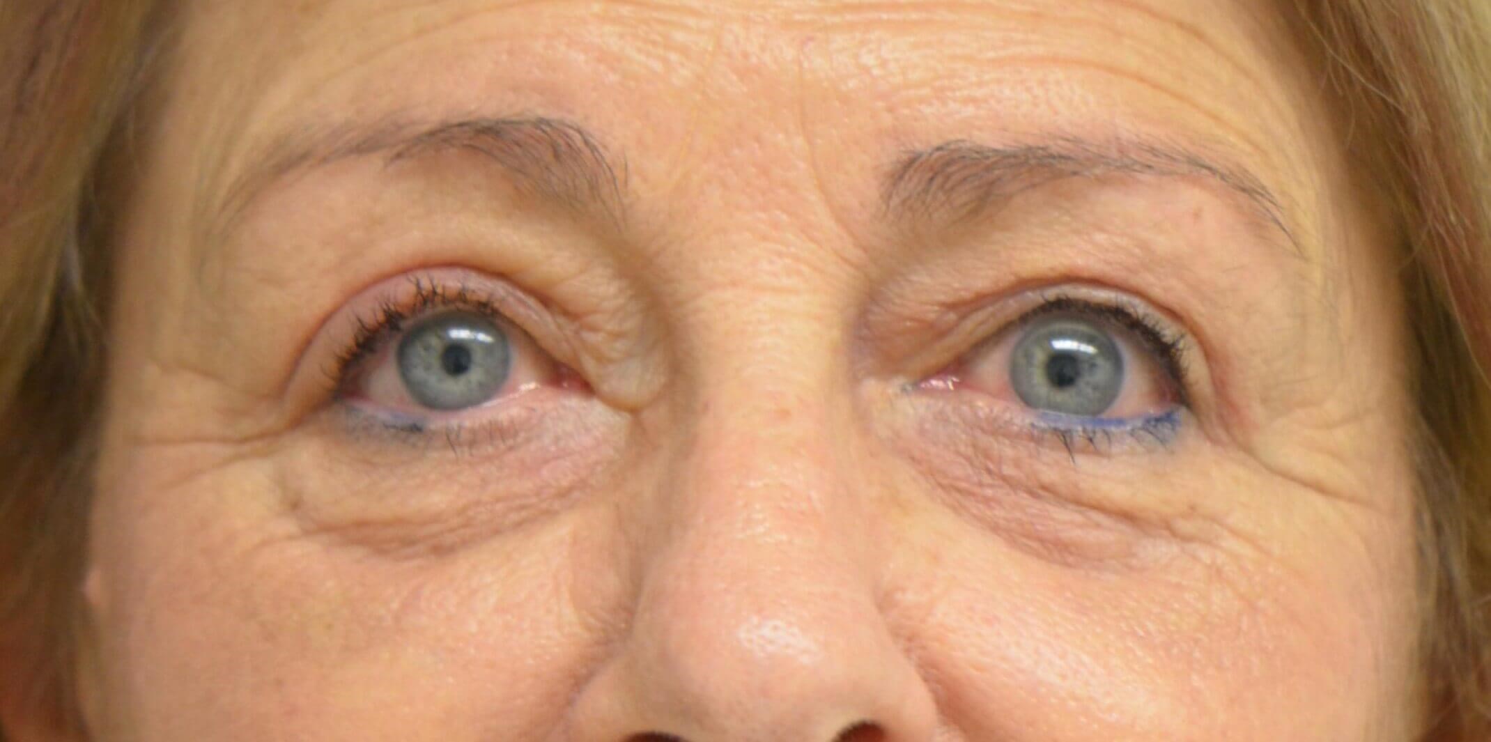 Blepharplasty Ptosis Repair After