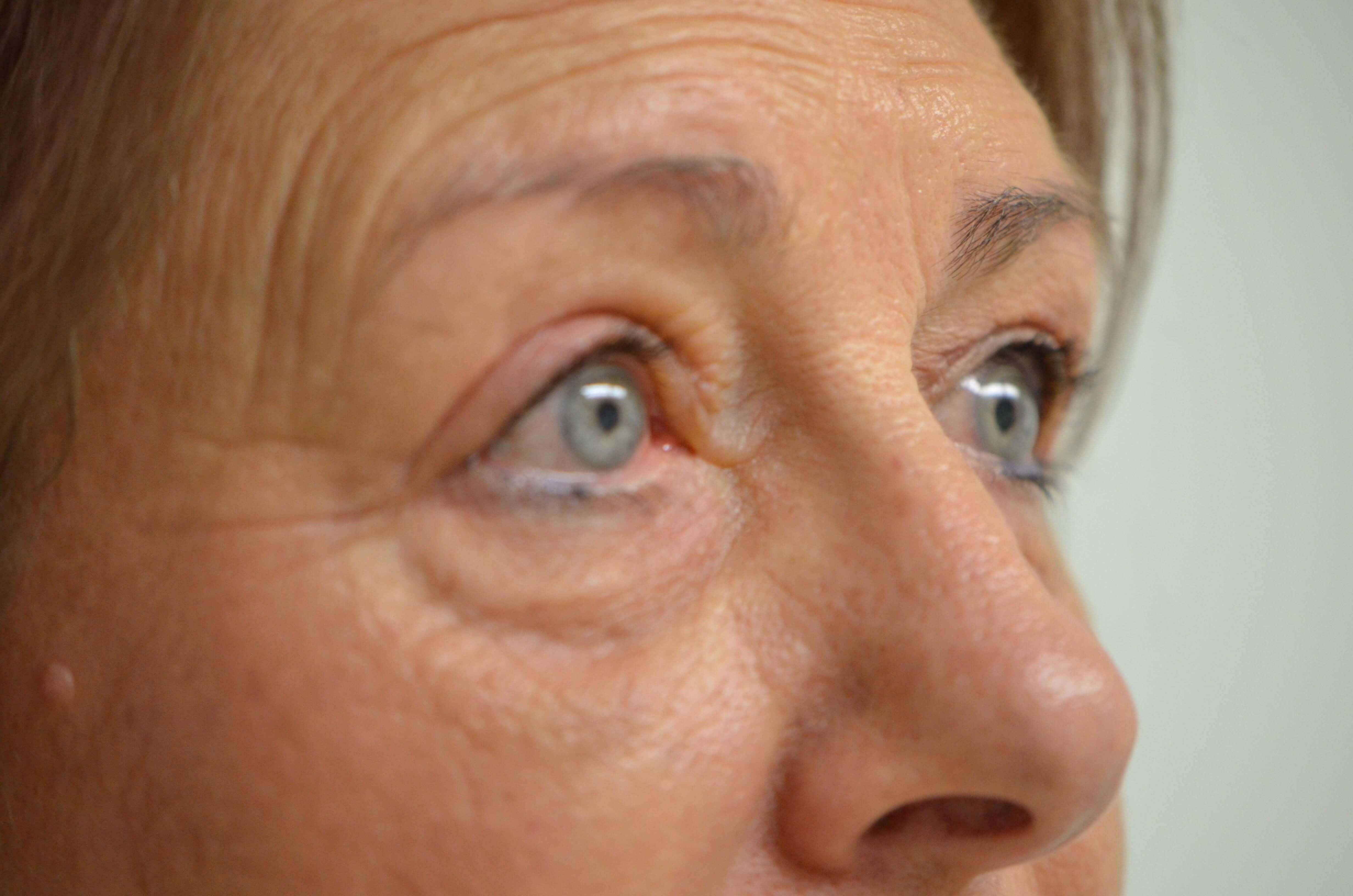 Blepharplasty Ptosis Repair After