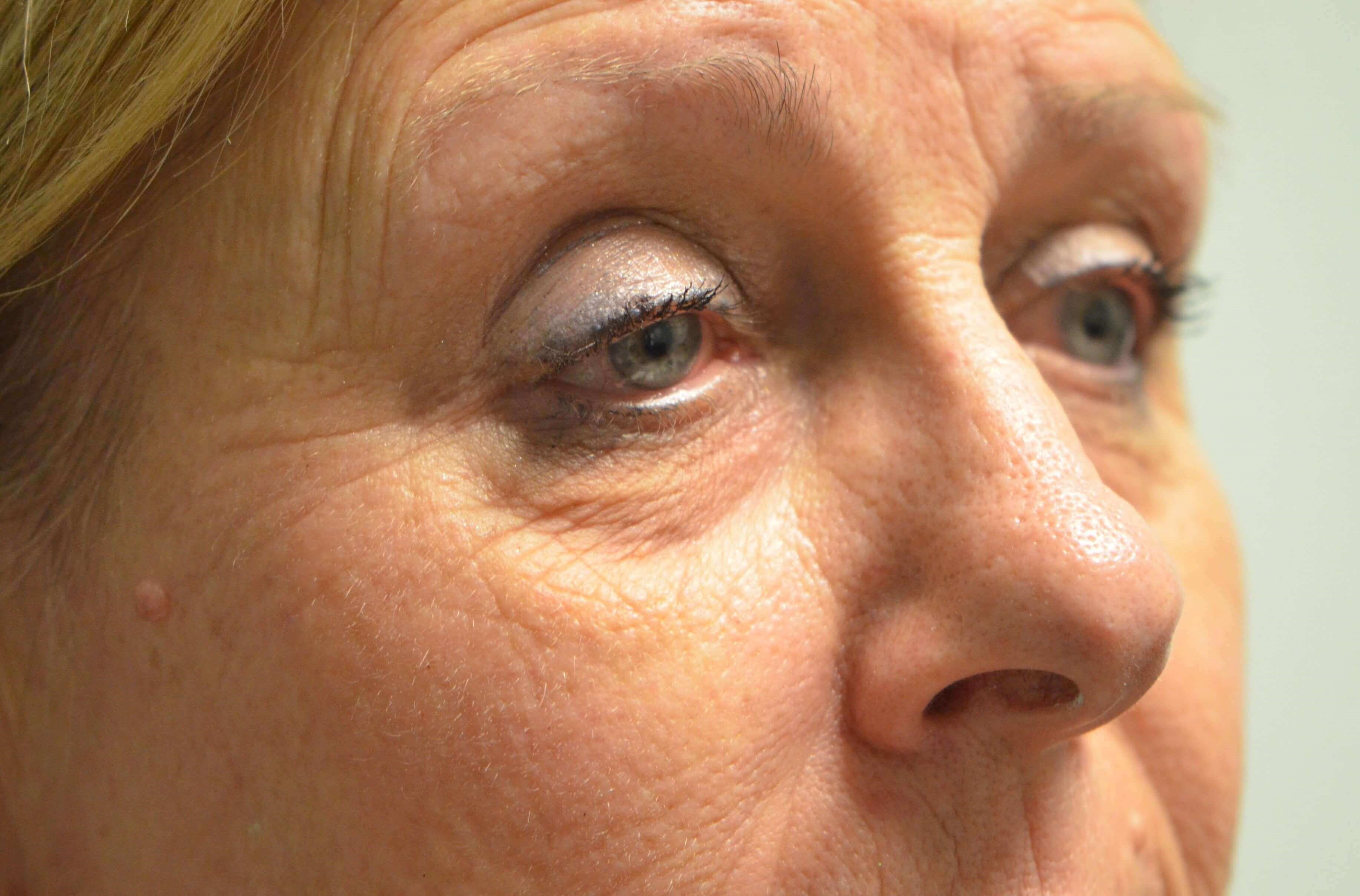 Blepharplasty Ptosis Repair Before