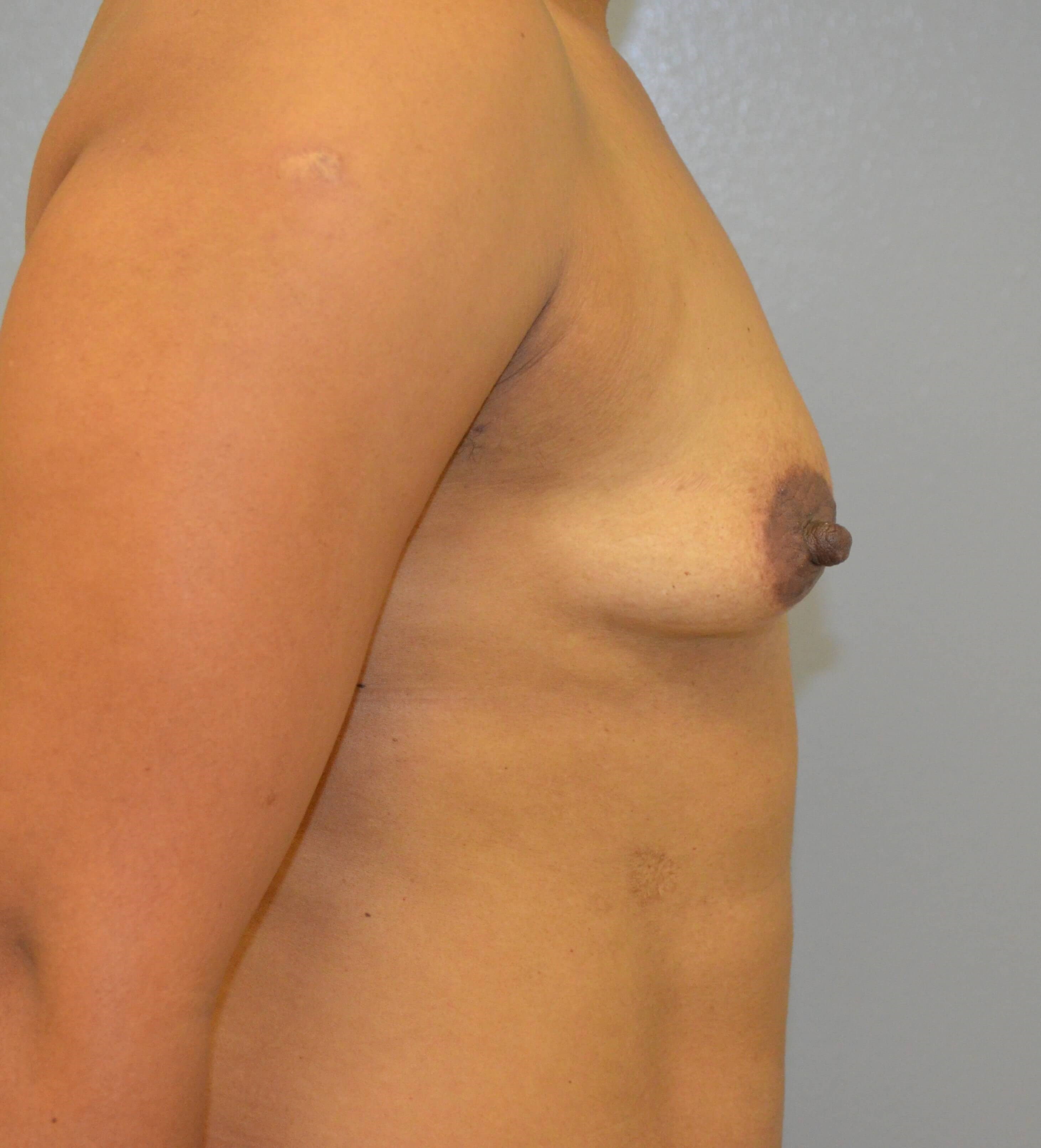 Breast Augmentation in Austin Before Lateral View 1