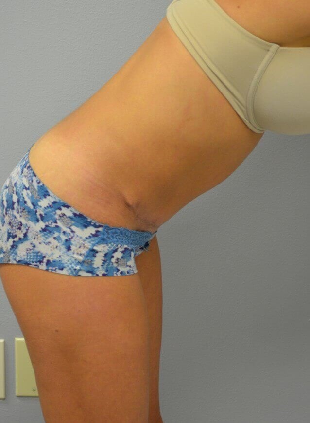 Lipoabdominoplasty After