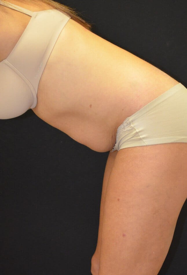 Lipoabdominoplasty Before