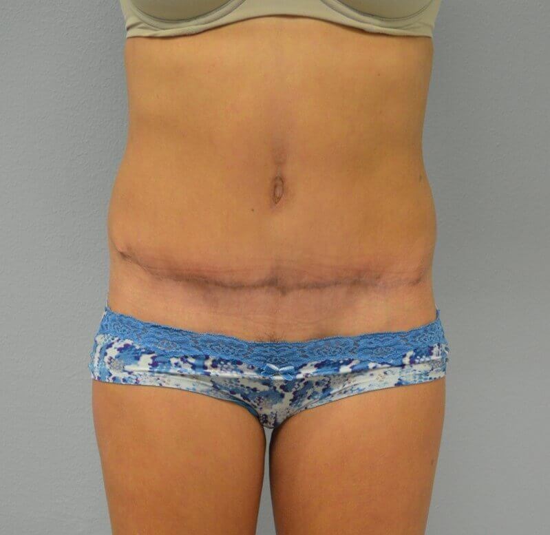 Lipoabdominoplasty After