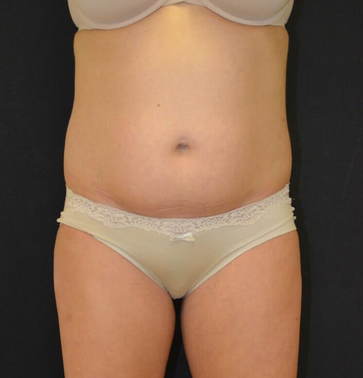 Lipoabdominoplasty Before