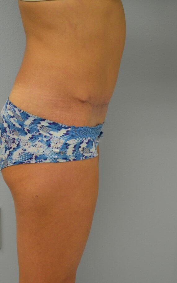 Lipoabdominoplasty After