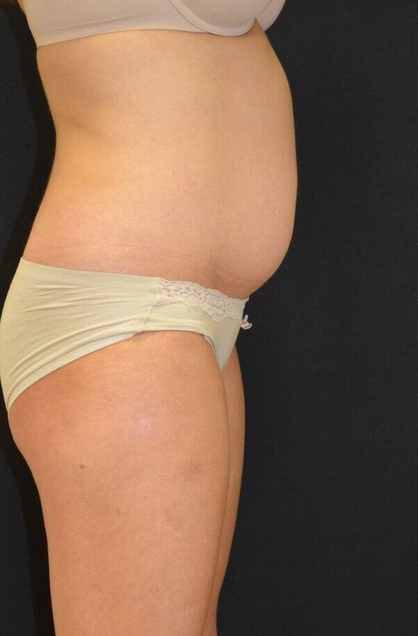 Lipoabdominoplasty Before