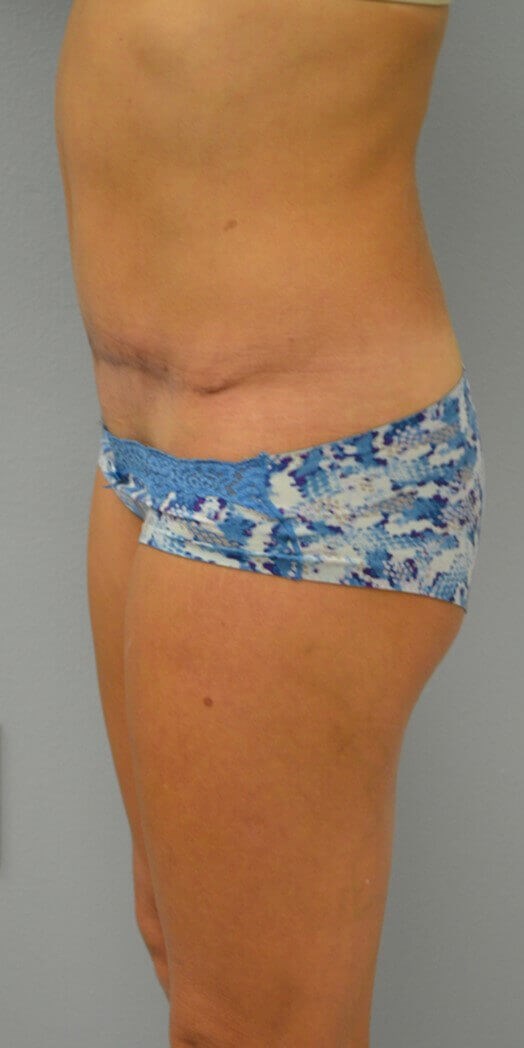 Lipoabdominoplasty After