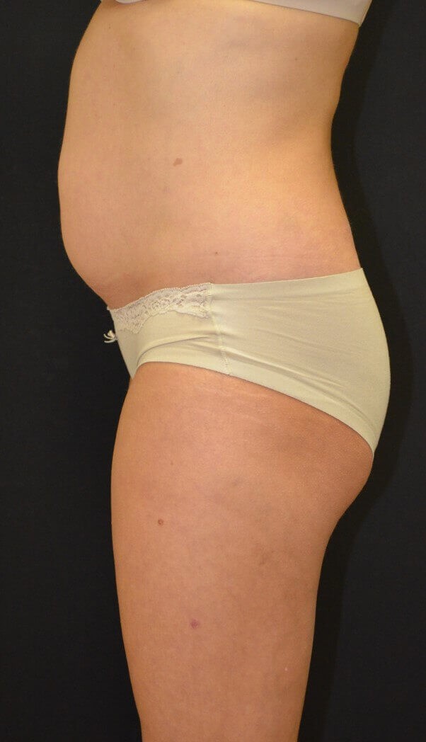 Lipoabdominoplasty Before